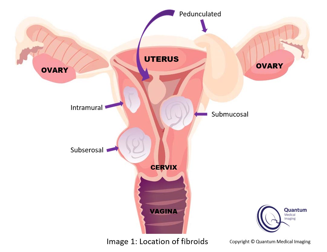 Uterine fibroids - Quantum Medical Imaging