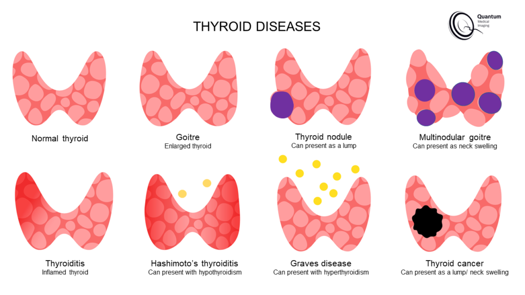 The Thyroid - Quantum Medical Imaging